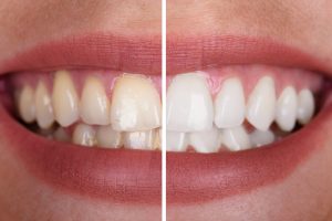 Zahnreinigung vorher - nachher